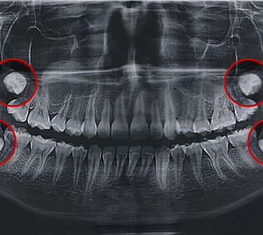 A dental X-ray that highlights a patient’s wisdom teeth