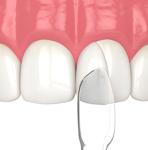 Illustration of dental bonding in Pasadena being performed on upper teeth