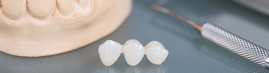 Dental bridge next to model jaw and dental instruments on reflective surface