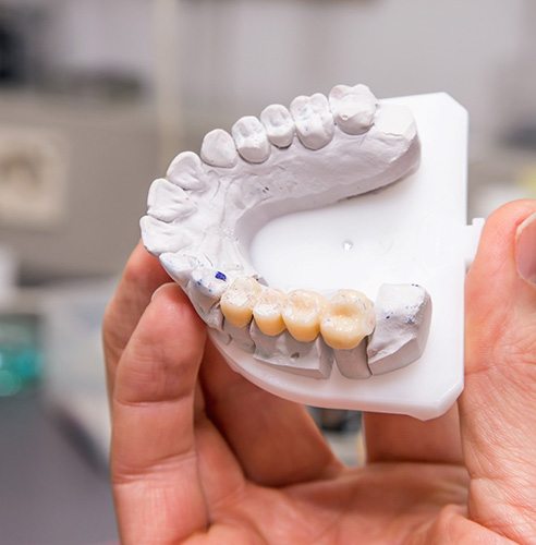 Hand holding model arch with bridge spanning several of the teeth