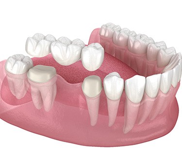 Illustration of a traditional dental bridge over abutment teeth with white background