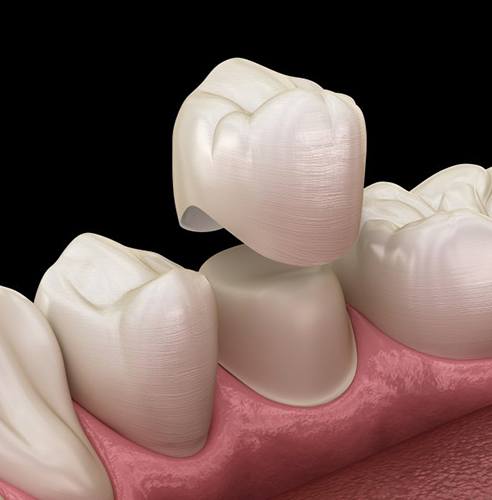 Illustration of dental crown and treated tooth