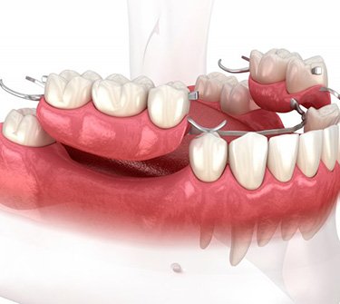 Illustration of partial dentures