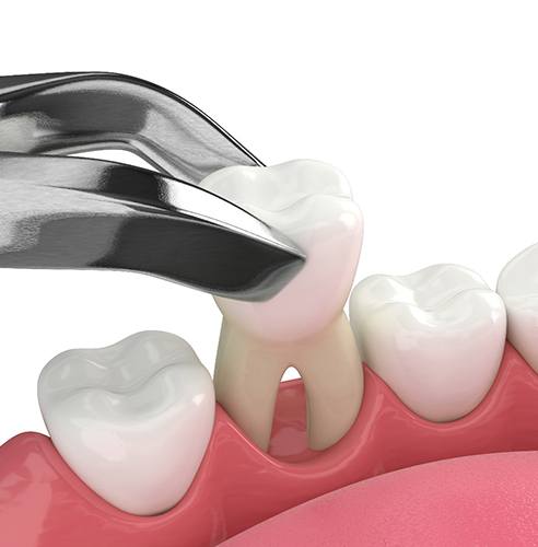 Illustration of a tooth extraction