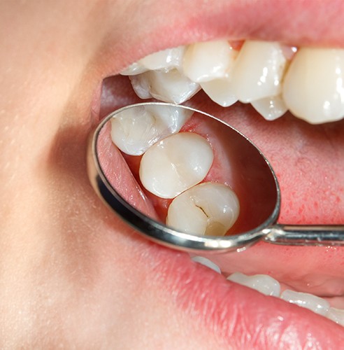 An illustration of a tooth-colored composite filling being placed on a tooth 